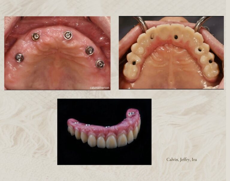 Advance Dental Implant