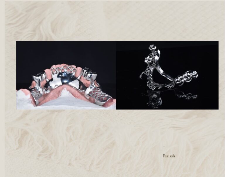 Frame Denture & Overlay