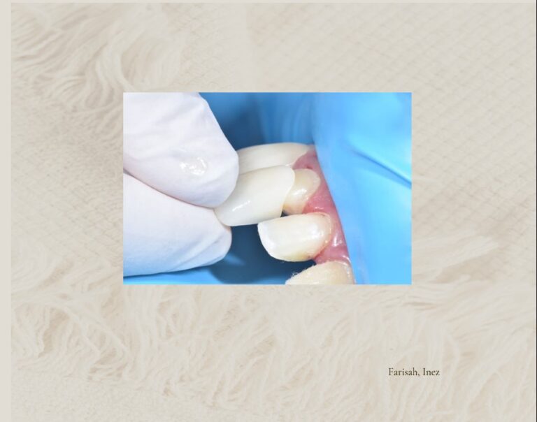 Full Crown Lithium Disilicate