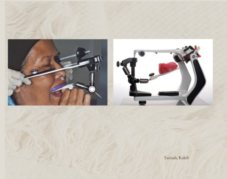 Gigi Tiruan Lengkap dengan Facebow Transfer