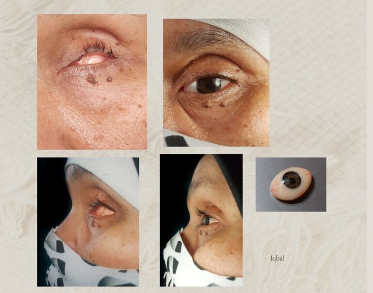 Ocular Prothesis