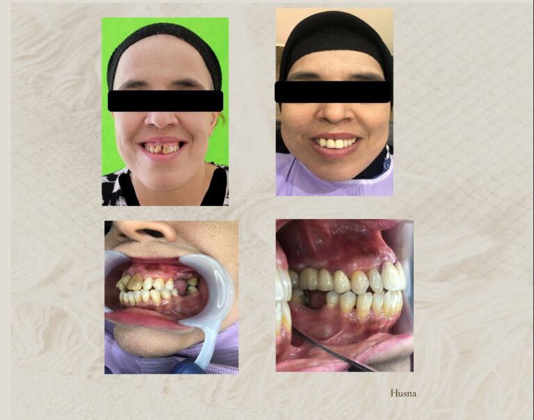 Pendekatan Korektif Prostodontik dengan Perbaikan Inklinasi Gigi Anterior